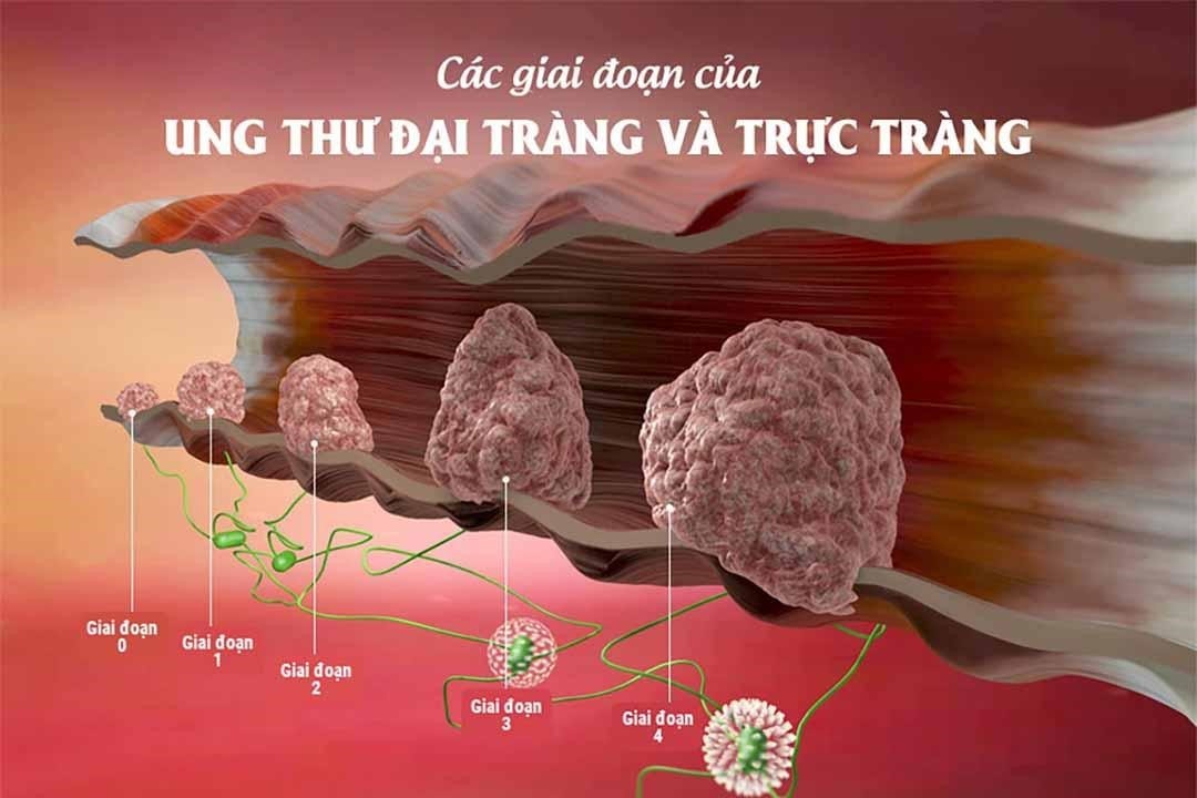 Các giai đoạn phát triển polyp tuyến dẫn tới ung thư đại trực tràng