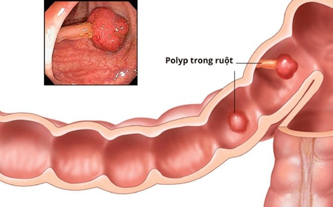 Tầm soát ung thư đại trực tràng bằng công nghệ nội soi sẽ phát hiện được các polyp