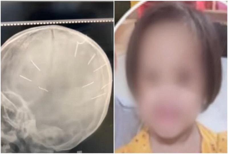 Hình ảnh 9 chiếc đinh đóng vào hộp sọ của cháu bé 3 tuổi. Ảnh: SK&ĐS