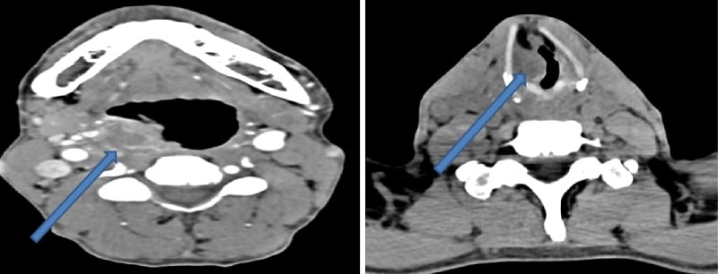 Chụp CT vùng cổ cho chẩn đoán u hạ họng (hình ảnh bên trái) và u hạ họng lan vào thanh quản (hình ảnh bên phải)