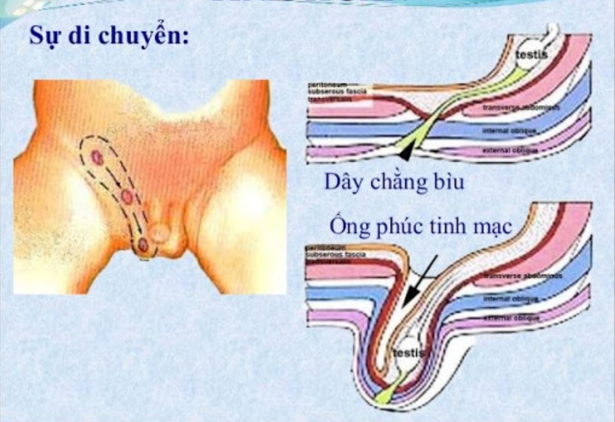 Nếu thấy con xuất hiện khối phồng ở vùng bìu, bẹn, cha mẹ nên đưa con đi khám ngay