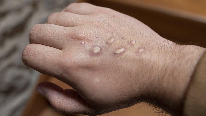 Cần phân bổ vaccine đậu mùa khỉ cho các khu vực để ưu tiên cho các đối tượng tiếp xúc gần bệnh nhân