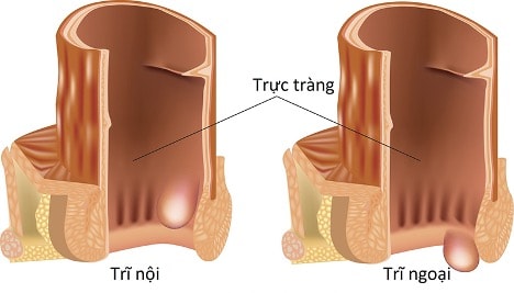 Trĩ gây ảnh hưởng không nhỏ đến chất lượng sống của người bệnh 