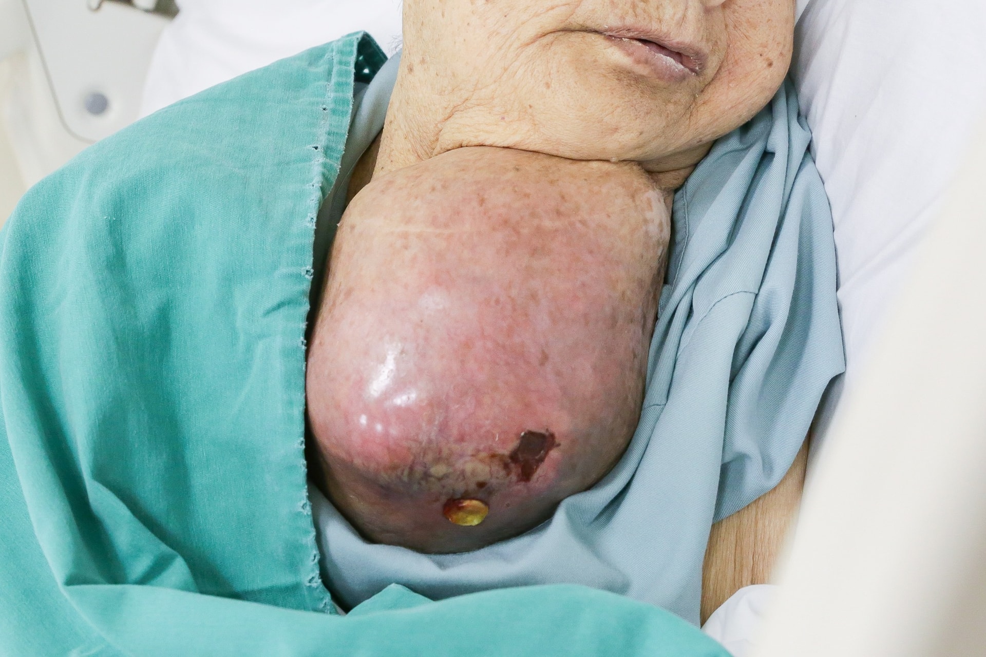 PR1_Khối u khổng lồ chèn ép vùng cổ bệnh nhân