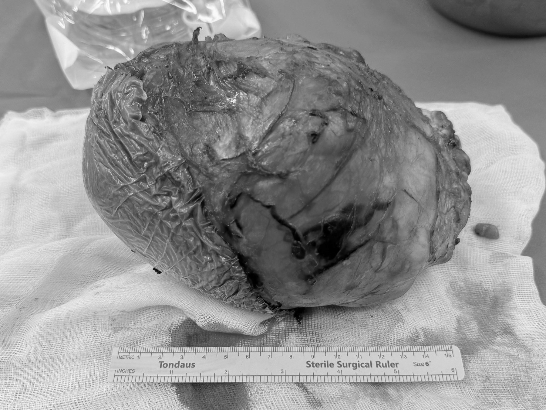 PR1_Khối u nặng khoảng 1,7kg