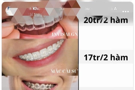 “Niềng răng giá rẻ”: Lời hứa đẹp, hậu quả đau