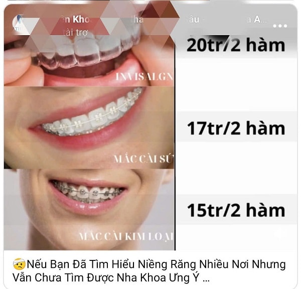 “Niềng răng giá rẻ”: Lời hứa đẹp, hậu quả đau