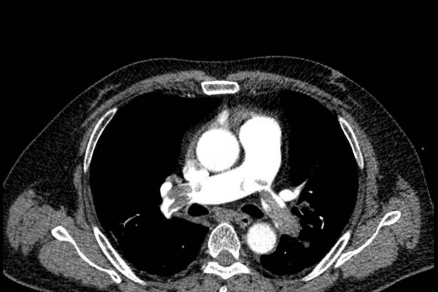 Cứu sống bệnh nhân bị thuyên tắc phổi liên quan đến hút thuốc lá